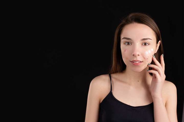 8-Tips-Against-Pimples
