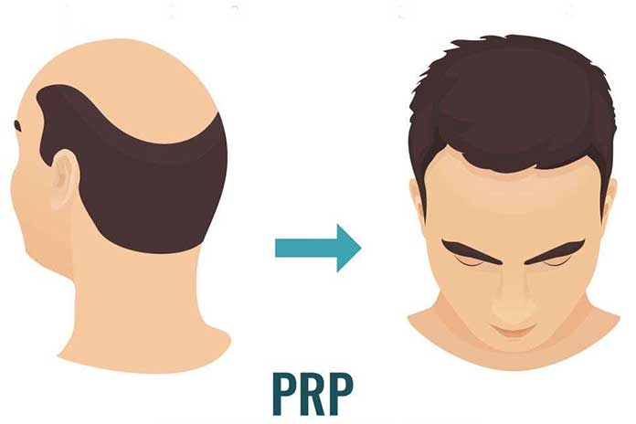 PRP-Treatment-After-Hair-Transplant