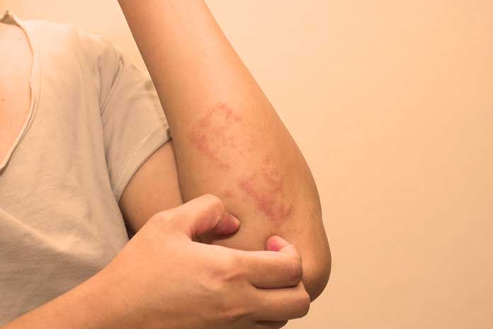 Natural Homeopathic Remedies For Dermatitis